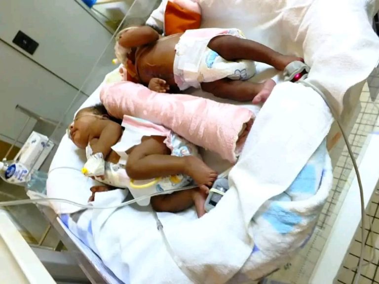 Goma : deux bébés siamois séparés avec succès, un exploit pour les médecins congolais !